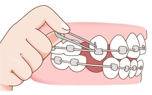 牙齒矯正期間點樣正確護理口腔？呢份超全指南幫你避免常見誤區同唔適感