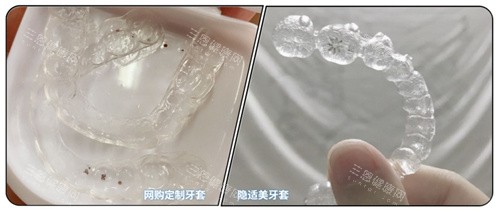 隐形牙套对比照片