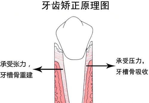 牙齿矫正正畸原理