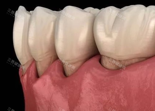 牙齦刮治後牙齦萎縮會修復嗎？醫師解析不可逆性及控製方法
