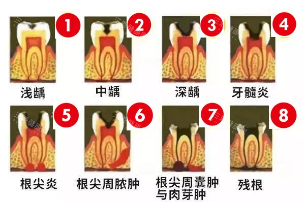 龋齿的情况