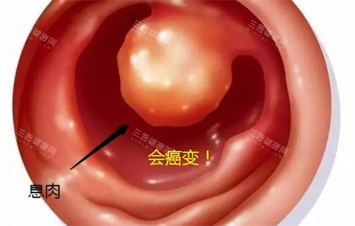 牙洞息肉