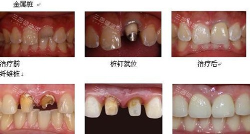 金属桩治疗前后示意图