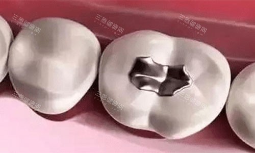 银汞合金的补牙术后