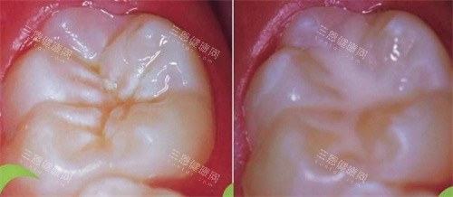 窝沟封闭前后