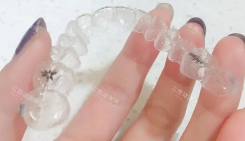 2025全新！時代天使隱形牙套價錢表大公開：1.5萬起包Comfos/標準/雙模版