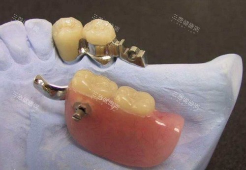 活動假牙值不值得做？價格/舒適度/使用壽命全解析看完再決定不踩坑！
