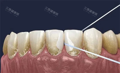 【洗牙必睇！】噴砂VS傳統洗牙：香港牙醫揭秘牙漬殘留率差5倍！