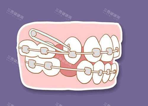 牙齿收缝卡通图片