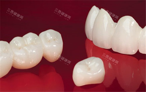 牙冠邊個品牌質量好？Lava、威蘭德、澤康、愛爾創、美加等都不错