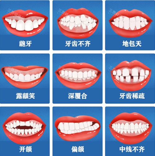 帶牙套可以改善“地包天”嗎？可以矯正“地包天”｜但須視乎“地包天”程度/年齡｜選擇合適矯正方法