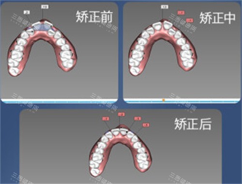牙齿矫正设计图
