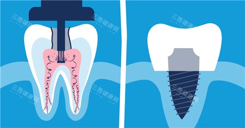 根管填充