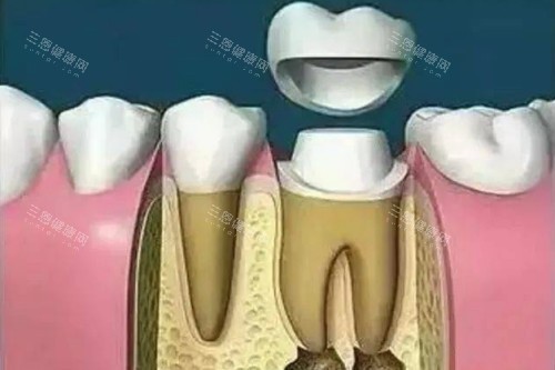 根管治疗戴牙冠卡通图