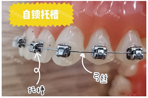 牙齿矫正自锁托槽牙套
