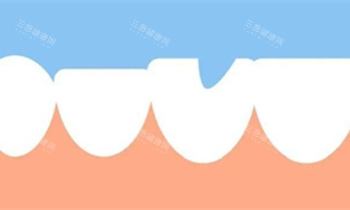 牙齿缺失一块展示图