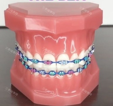 25歲還有必要矯正牙齒嗎？壹文解析牙齒矯正較佳的年齡、以及矯正牙齒優缺點！
