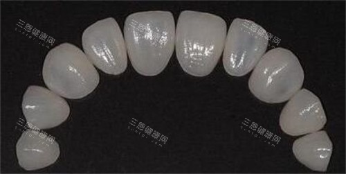 牙贴面修复改善