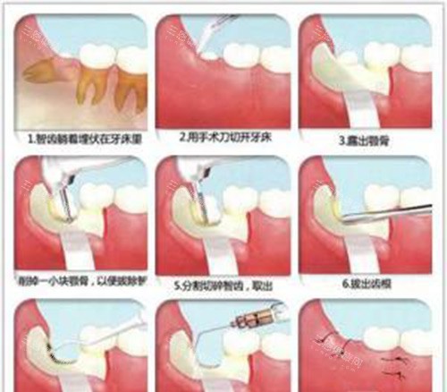 剝智慧齒避坑指南：香港vs深圳價差5倍，感染控制更緊要!