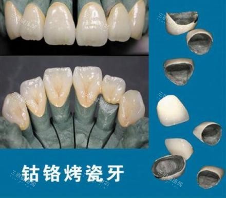 深圳牙冠多少錢壹顆？親測整理全瓷牙VS烤瓷牙真實報價清單！烤瓷牙800元起、全瓷牙1380元起！