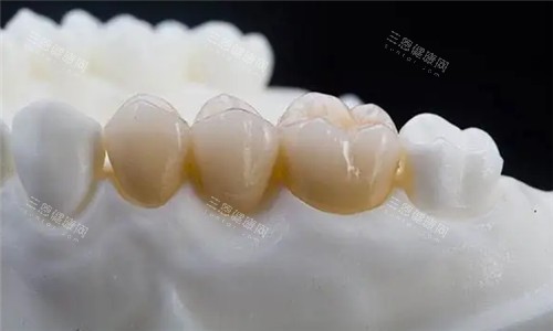 全瓷牙冠图