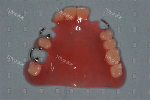 鑲半口牙要多少錢？固定義齒和活動假牙價格大公開，選對能省好幾千！