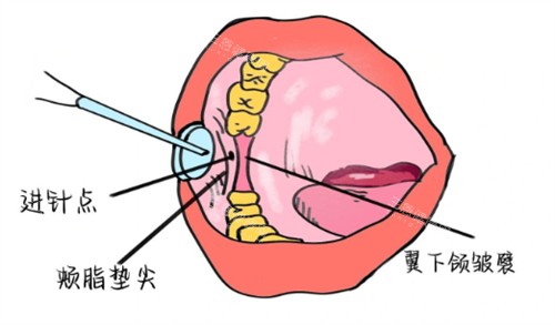 牙周韧带内注射麻醉