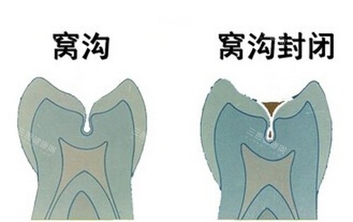 兒童窩溝封閉壹顆牙幾錢？壹文搞掂價錢、必要性同埋風險！