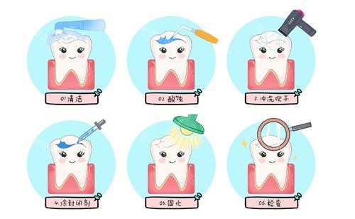 窝沟封闭治疗过程动漫图
