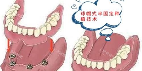 漫画半口种植牙示意图