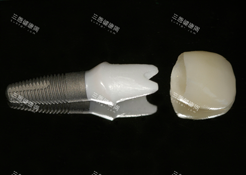嚇親！深圳概念彙口腔種牙收費幾多？超詳盡種植牙價格表大揭秘