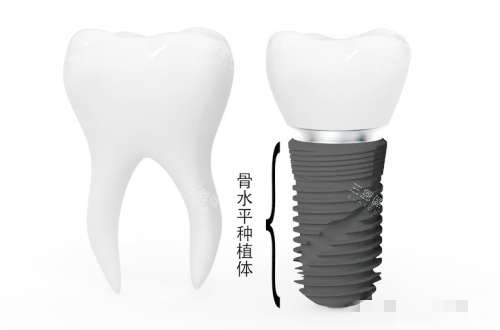 2025深圳君信民泰口腔門診部價錢查詢：種牙植牙1280+牙箍4800+補牙100+價格劃算透明