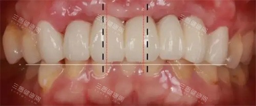 牙齿修复数据测量