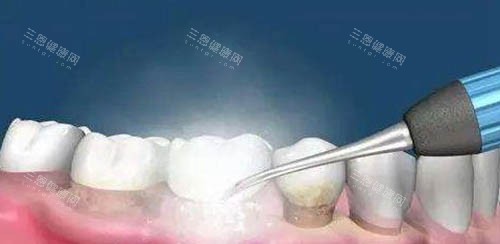 【洗牙小知識】噴砂潔牙能美白牙齒嗎？介紹噴砂潔牙優缺點、價格多少錢？