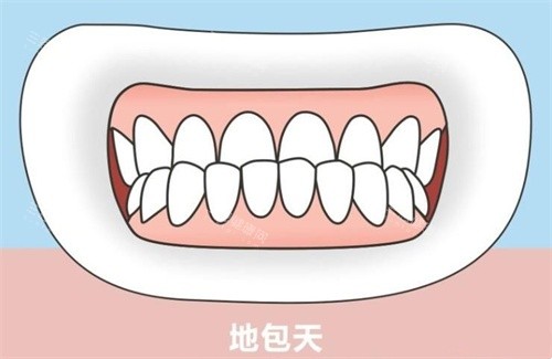 小孩地包天矯正需要多長時間？大概什麼價位？早期幹預半年起效，乳牙期、替牙期矯正時長、花費一文說清