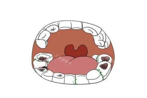 牙齿蛀牙问题卡通图