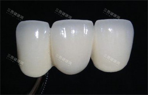 全瓷冠可以撐多久？關鍵不在材料貴，而在這幾件事！必學日常保養秘技，輕鬆延長10年使用期！