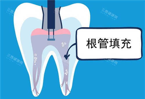 根管填充图示