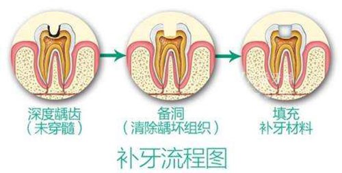 香港補牙幾錢一個？樹脂補牙600-800港幣起，兒童玻璃材質補牙500港幣起