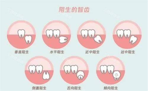 智慧齒拔了好定唔拔好？專科醫生話你知智慧齒需唔需要拔，睇下唔拔有咩危害