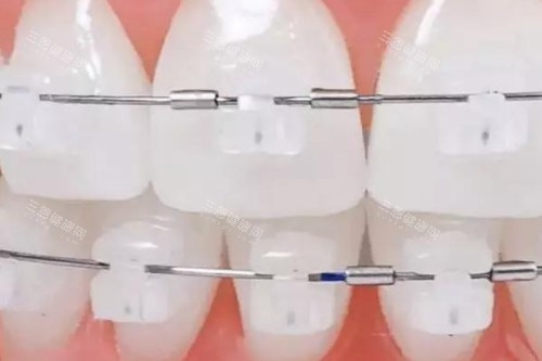 陶瓷半隐形矫正模型图