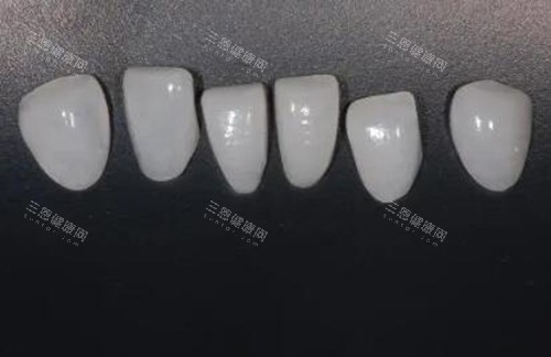 牙齿贴面修复改善