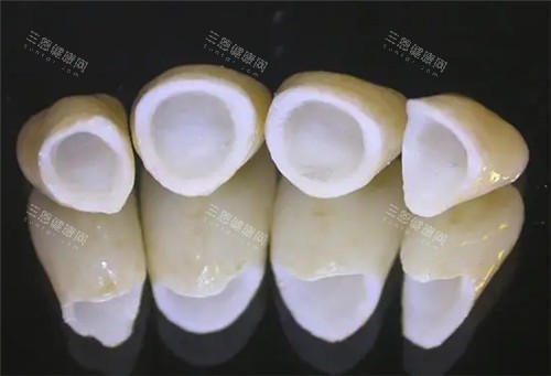 全瓷牙连桥冠照片