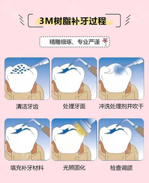 2025深圳補牙價格表：填充式138元起，嵌體2000元起，10家口碑醫院推薦，比香港更優惠