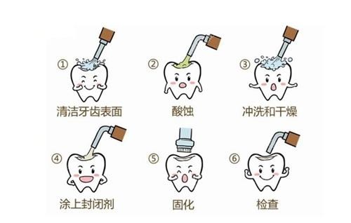 窝沟封闭流程图