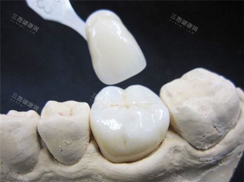 瓷牙貼片壽命有幾長？一文拆解影響因素同保養貼士