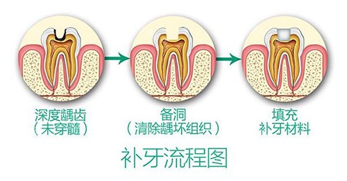 补牙流程