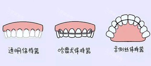 隱形矯正對於女性有年齡限制嗎？真相一覽無遺！
