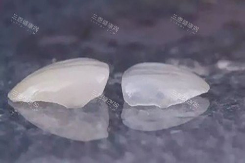 想整靚牙齒又擔心磨牙會傷害真牙？陶瓷貼片一定要磨牙嗎？