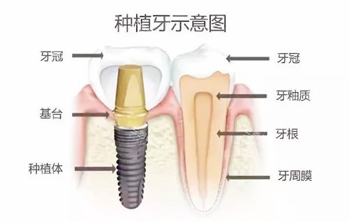 親身體驗！深圳種牙邊間好？鼎植/拜博/啓正/益齒佳實測大揭秘